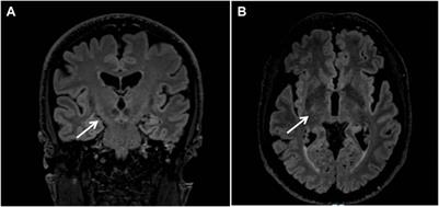 The genetic puzzle of a SOD1-patient with ocular ptosis and a motor neuron disease: a case report